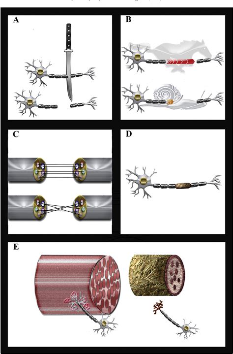 Figure 1 From Surgical Repair In Humans After Traumatic Nerve Injury