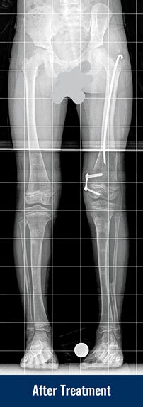 Bone Deformity | International Center for Limb Lengthening