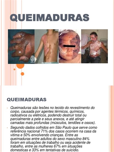 Seminario Queimaduras Queimadura Primeiros Socorros