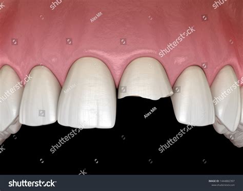 Broken Central Incisor Tooth Medically Accurate Stock Illustration ...