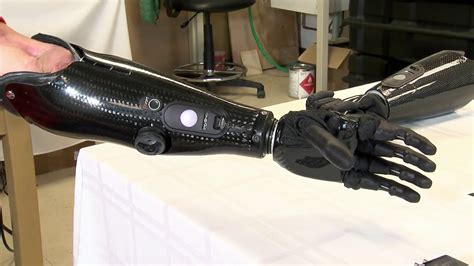 Bionic arm made by UI alum is changing the world of prosthetics | WRSP