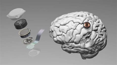 Neuralink Comparte Un Vídeo Del Primer Humano Con Su Implante Cerebral