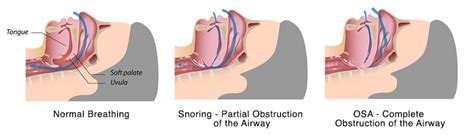 Snoring And Obstructive Sleep Apnea