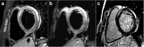 Typical Findings Of Myocarditis On Cmr 16 Year Old Patient With A