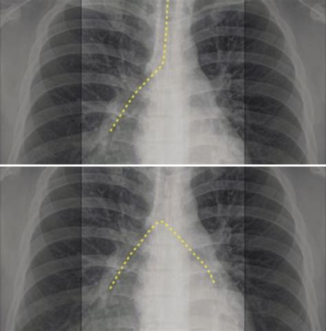 Radiology Block 2 Intro Heart Great Vessels Chest Radiography