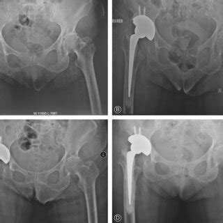 A Preoperative Anteroposterior Ap Radiograph Of The Left Hip In A