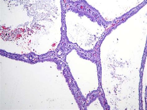 Mixed Epithelial And Stromal Tumor Bosnianpathology