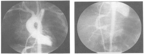 A B Cine Angiogram Postero Anterior Views Left Ventricular