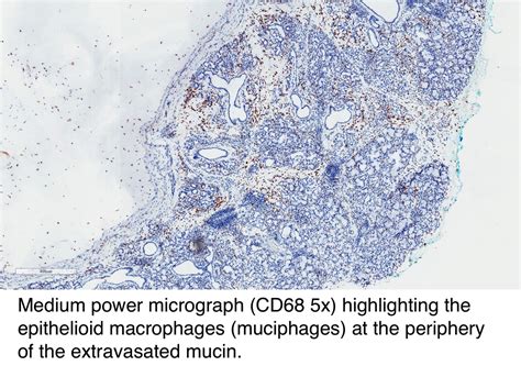 Pathology Outlines Mucocele