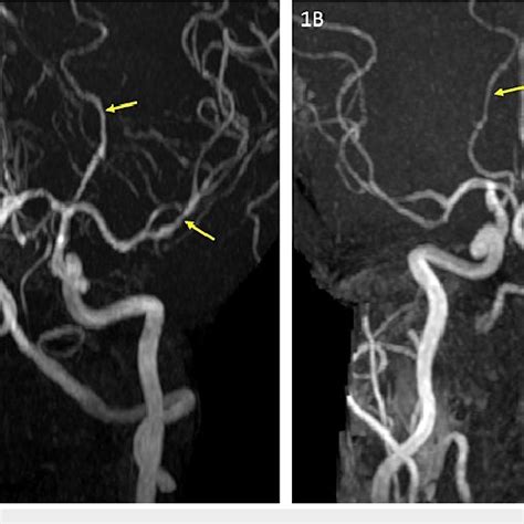 Magnetic Resonance Angiogram A Maximum Intensity Reconstruction From