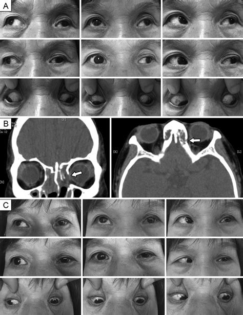 A New Application Of Modified Nishida Muscle Transposition Procedure