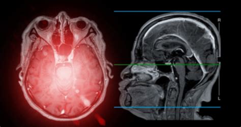 Recognizing The Warning Signs Of A Stroke