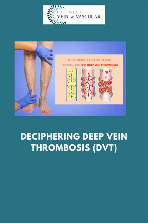 Deep Vein Thrombosis Treatment Vein And Vascular Care Clinic