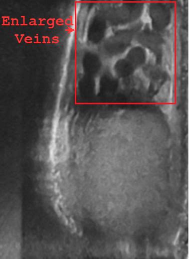 Ultrasound Of A Testicle Showing Normal And Enlarged Veins Varicocele