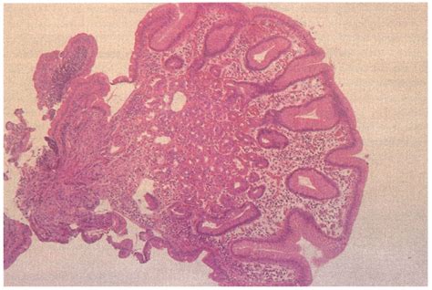 Biopsy Taken From The Duodenal Bulb He Staining The Ectopic