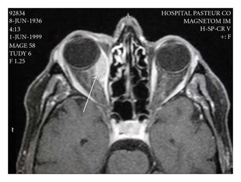 High Signal Intensity On Mri Images In An Orbital Myositis Related To