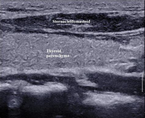 Grey Scale Ultrasound Longitudinal Section Of Left Lobe Of The