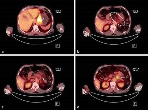 A Positron Emission Tomography Computed Tomography Revealed Advanced