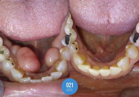 T Rus Mandibular O Que Quais As Causas E Tratamentos