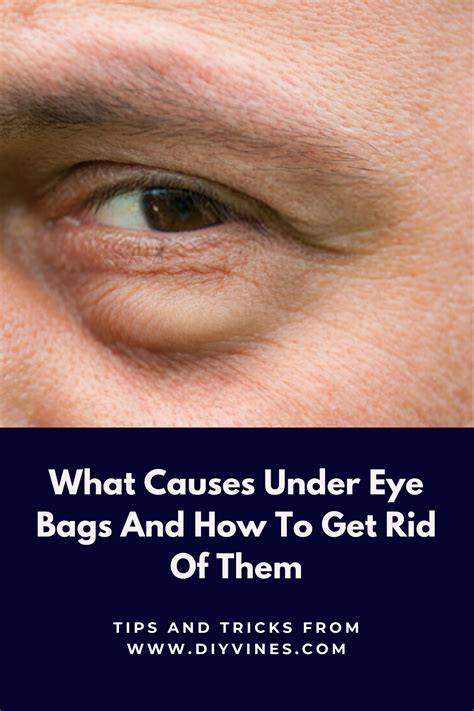 Causes Of Under Eye Bags