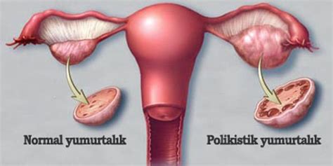 Polikistik Over Nedir PCOS Op Dr Gönül Çimen