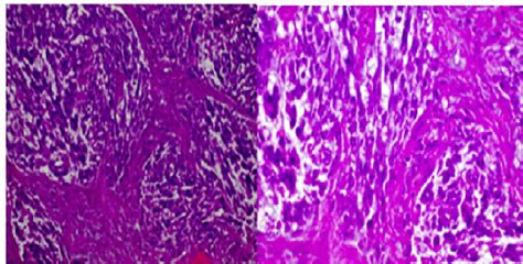 Histopathology Of The Incisional Biopsy Of The Lesion Download