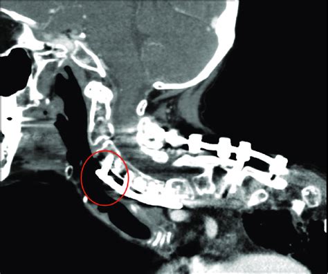 Sagittal View Of The Neck With Contrast Enhanced Computed Tomography