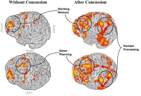 Blows To The Head Can Be Just As Dangerous As A Concussion Siowfa