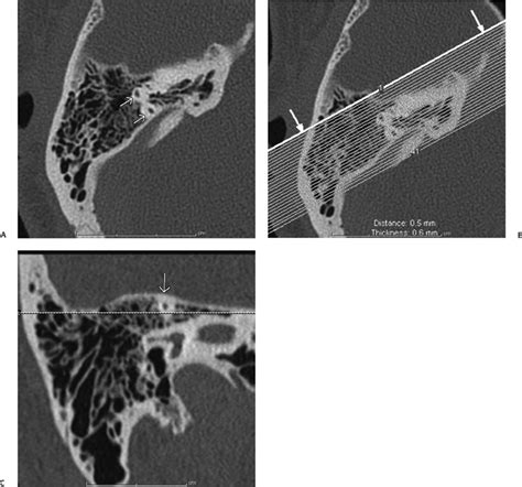 Temporal Bone Imaging Technique Radiology Key