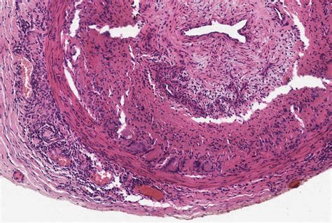 Multinucleated Giant Cells - GCA Histology