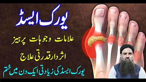 Uric Acid Ka Ilaj High Uric Acid Treatment In Urdu How To Reduce