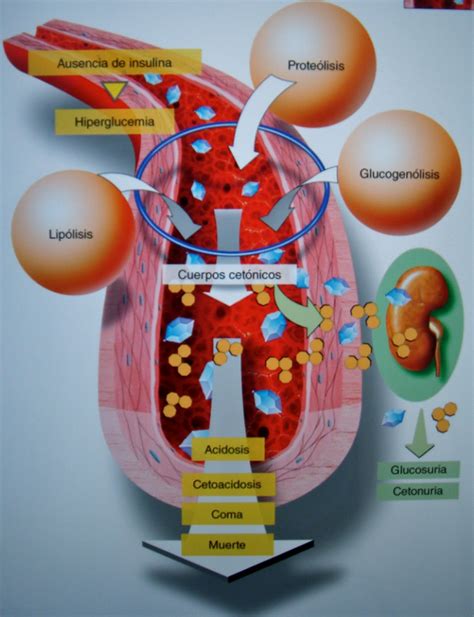 Cetoacidosis Diabética Casa Del Diabético Vidabetic Viviendo Con