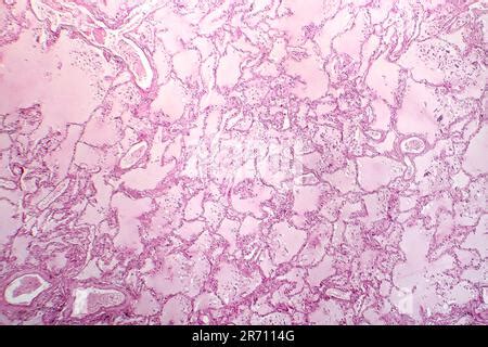 Histopathologie de l œdème pulmonaire aigu micrographe léger montrant