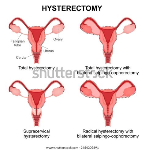 Types Hysterectomy Medical Illustration Stock Illustration 2454309891