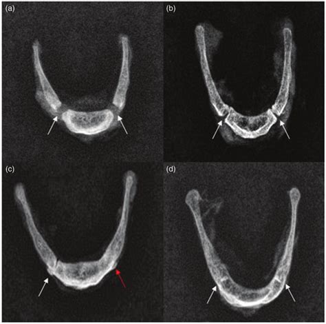 X-ray images of hyoid bone fusion stages. (a) Hyoid bone showing fusion ...