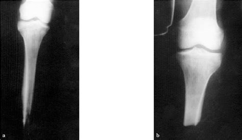 Figure 2 from Inferior dislocation of the proximal tibiofibular joint ...