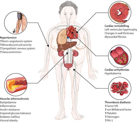 Complications Of Cushings Syndrome State Of The Art The Lancet