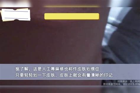 小伙后背皮肤清晰显出巴掌印，密麻毛孔超瘆人，得知真相网友惊呆