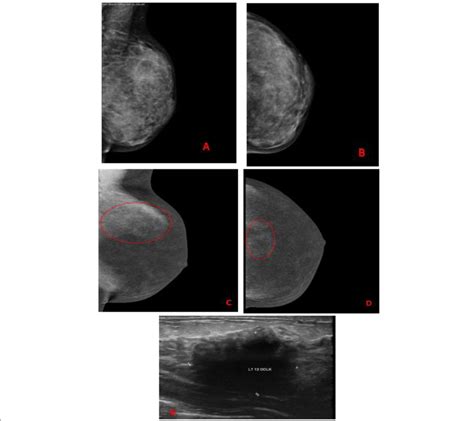 A 33 Year Old Female Patient Presented With Left Breast Lump Of 3