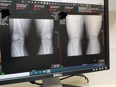 Update Open Wedge High Tibial Osteotomy Before Image2 Years Post