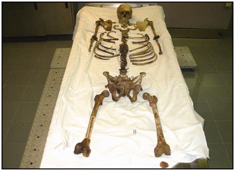 Discovering A Double Murder Through Skeletal Remains A Case Report Samuele Manzoni Andrea