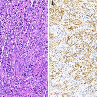 Morphological And Immunohistochemical Features In Case A