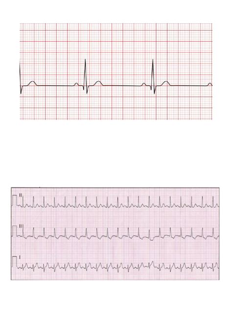 Tipos de Ecg | PDF