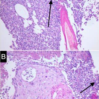 A And B Histologic Sections Of A Punch Biopsy Show Squamous