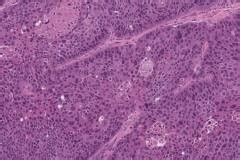 HPV-independent squamous cell carcinoma of the oropharynx | Ottawa ...