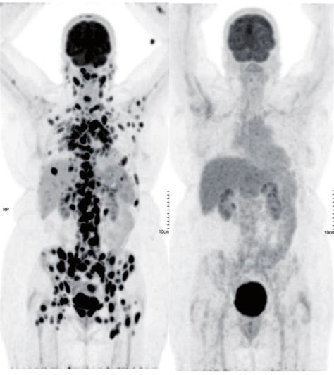 PET CT Scan Showing Marked Improvement After Initiation Of