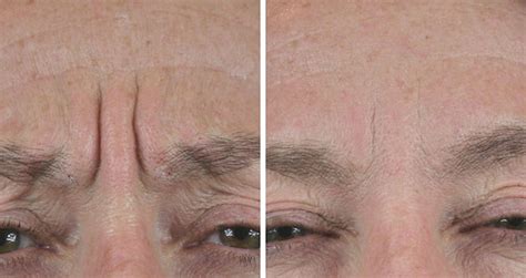 Frown Line Removal Soften And Smooth Frown Lines With Botox