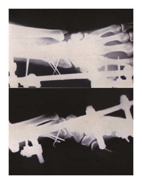 Preoperative A Postoperative B And Final Follow Up Radiographs Of