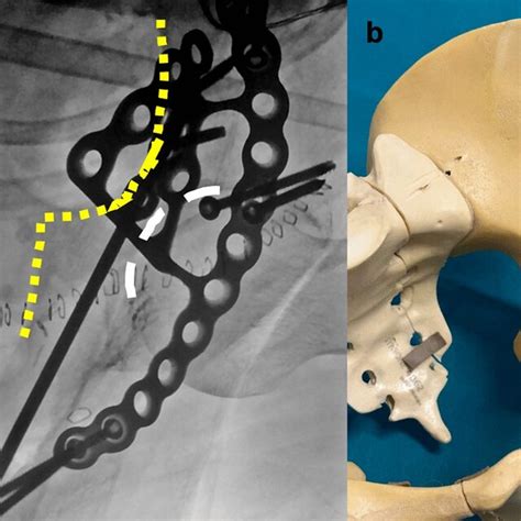 Cross Table Lateral View A Fluoroscopic View Shows Profile Of