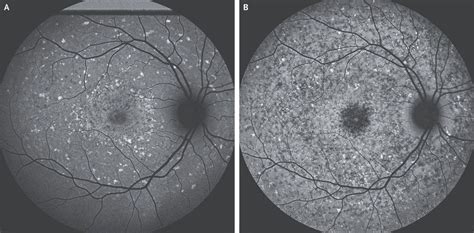 Stargardt Juvenile Macular Degeneration Medizzy